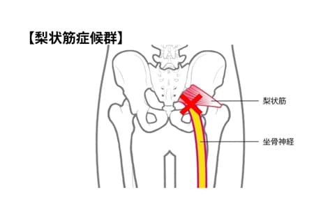 梨状筋症候群
