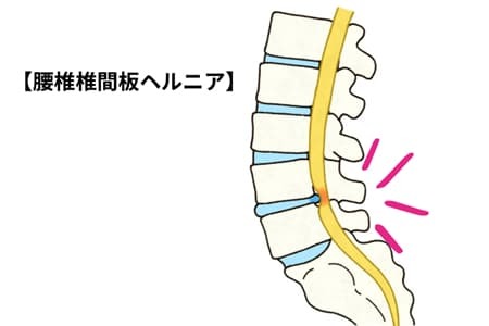 腰椎椎間板ヘルニア