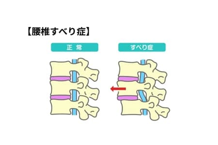 腰椎すべり症